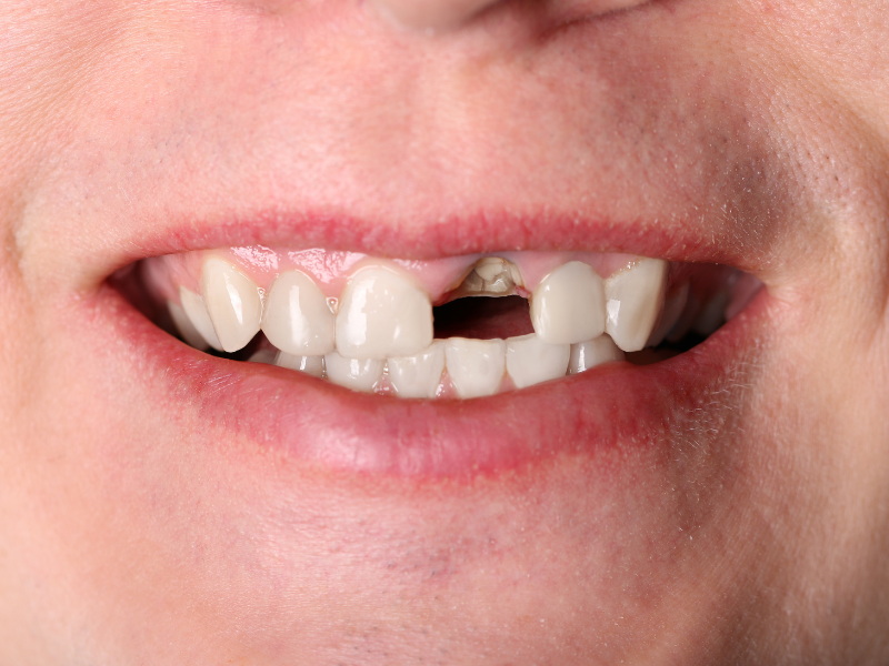 dental implant_1