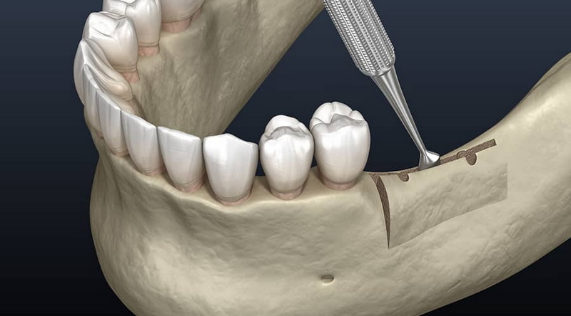 how long does dental implant healing take_06