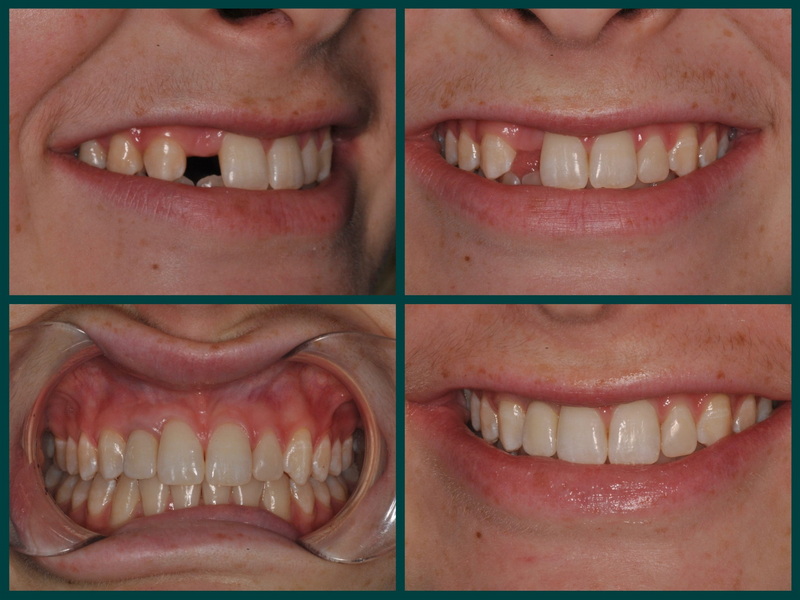 What Is Basal Dental Implant?