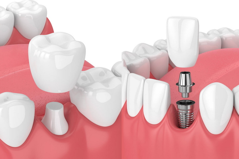 what is the best type of dental implant