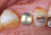 //iirorwxhloqjli5p.ldycdn.com/cloud/lqBpkKloljSRrljkjmoijo/encode-healing-abutment.jpg
