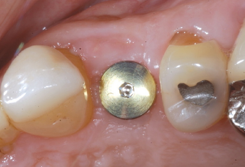 encode healing abutment