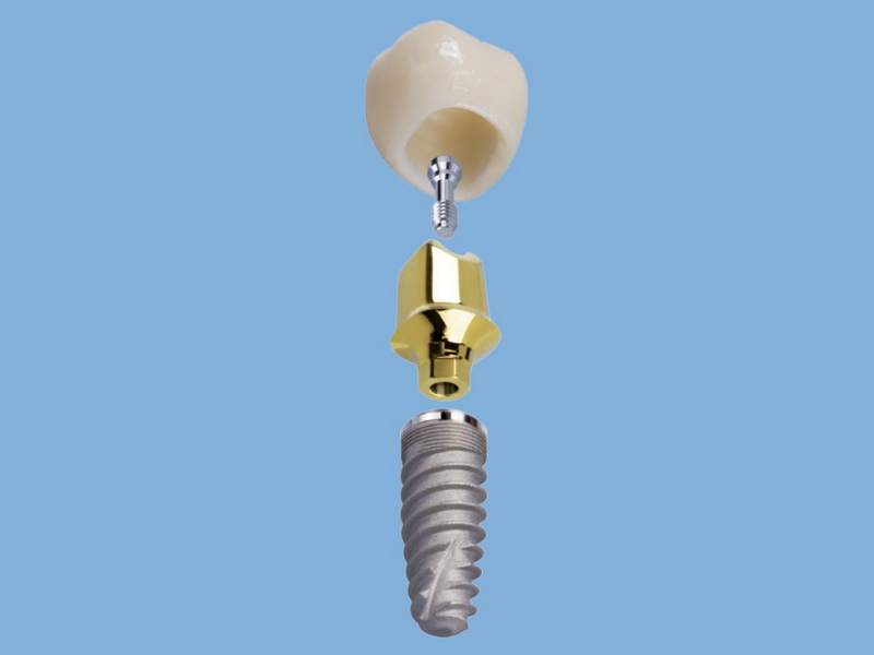 How Does A Dental Abutment Work in Implant Procedures?