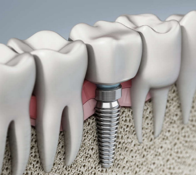 Can You Workout After Dental Implant?