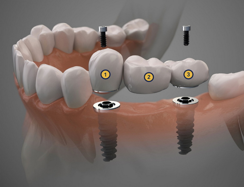 multi unit healing abutment