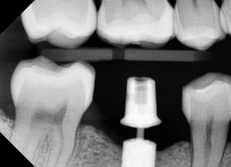 How Can I Prevent My Healing Abutment From Getting Loose?