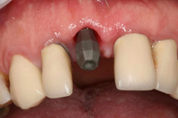 //iirorwxhloqjli5p.ldycdn.com/cloud/lqBpkKloljSRrlmkkmjqjq/healing-abutment-dental-code.jpg