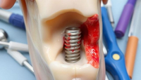//iirorwxhloqjli5p.ldycdn.com/cloud/lqBpkKloljSRrlmlolrrjo/dental-implant-healing-abutment-pain.jpg