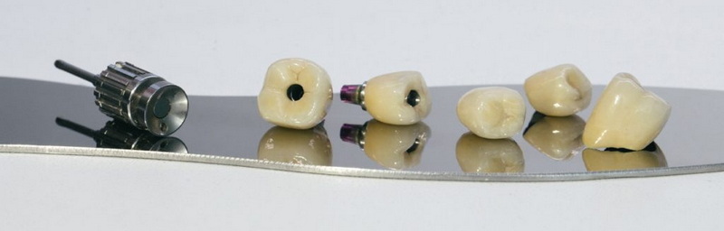 Can A Loose Healing Abutment Affect My Dental Implant?