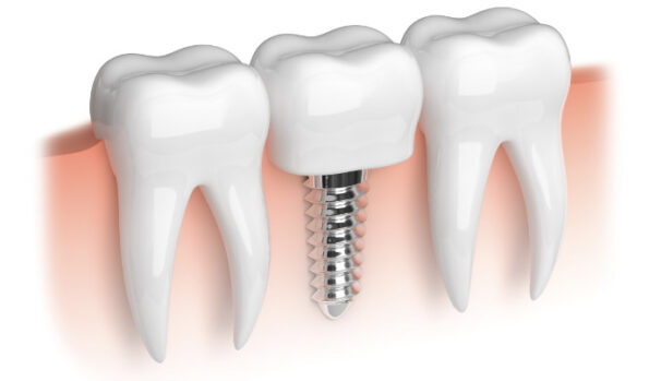 can you serve in military with a dental implant