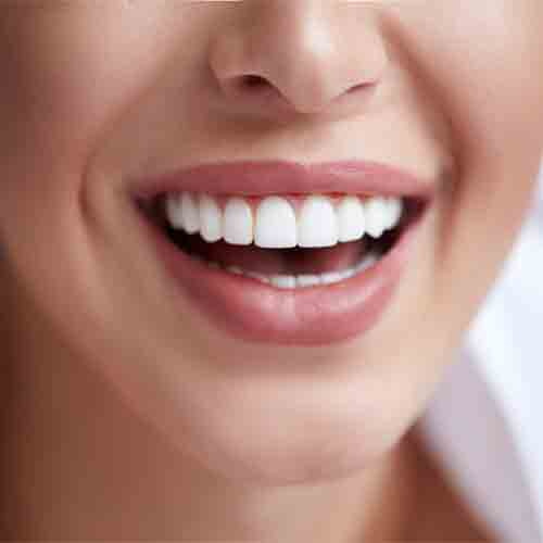 can you put a veneer over a dental implant