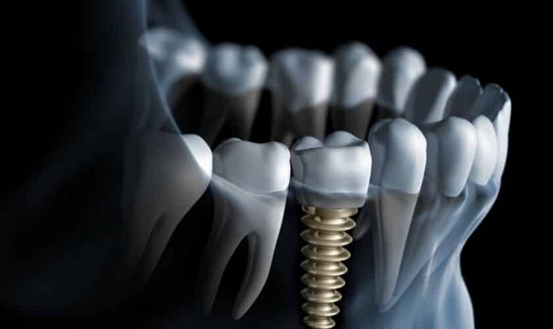 can i sing after dental implant