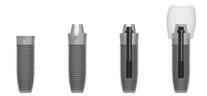 healing abutment screw fell out