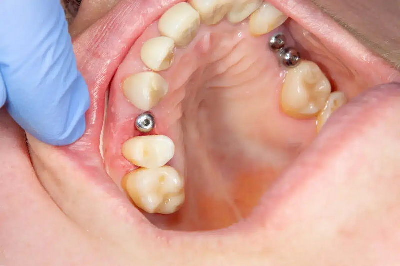 can a dental implant crown be placed backward