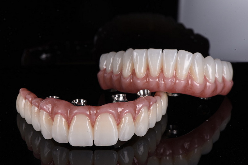 can a dental implant shift