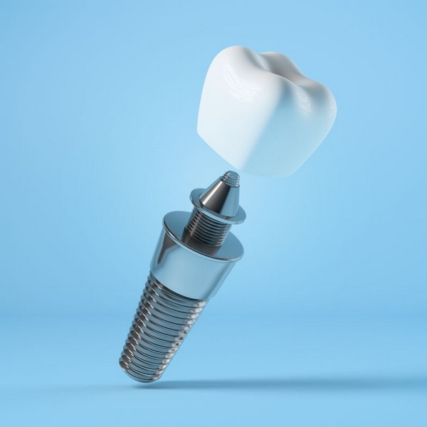 Can Dental Implant Be Deduced From Taxes?