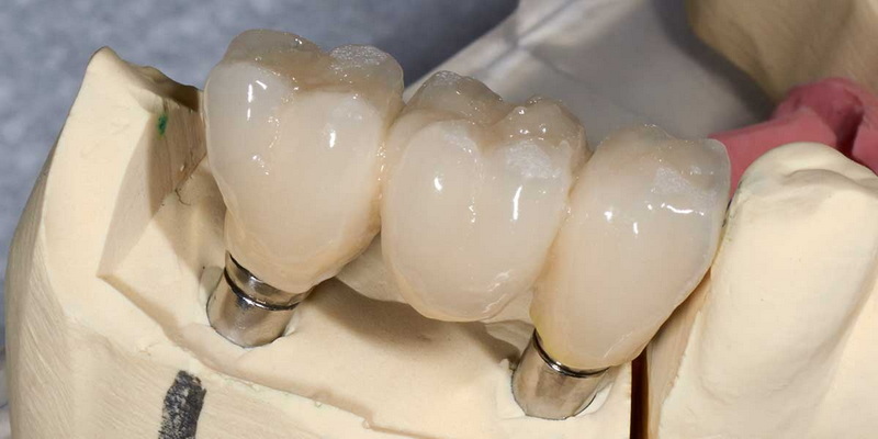 can an mri be given after a dental implant
