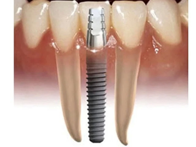 can a stain on a dental implant be fixed