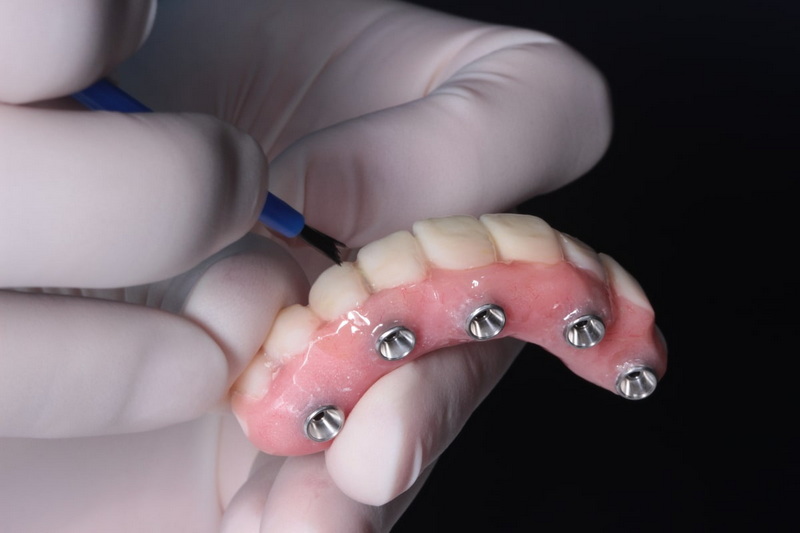 Can A Loose Dental Implant Heal?