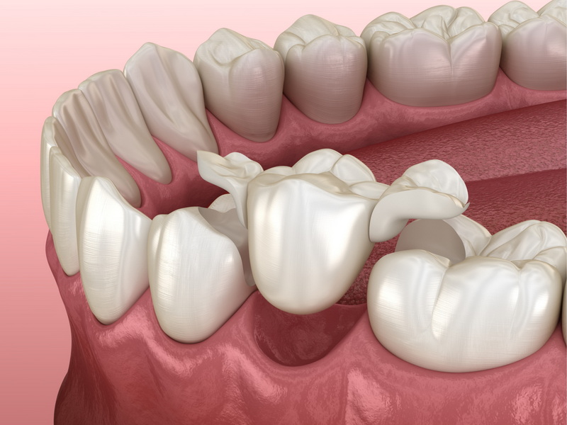 can dental implant be covered under concordia dental insurance
