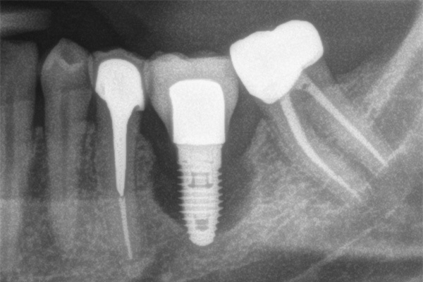 what can you not do after dental implant surgery