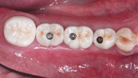 //iirorwxhloqjli5p.ldycdn.com/cloud/lrBpkKloljSRilliikinjo/nobel-biocare-healing-abutment.jpg