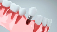 //iirorwxhloqjli5p.ldycdn.com/cloud/lrBpkKloljSRilnimrqkjq/do-you-have-to-have-anesia-for-dental-implant-surgery.jpg
