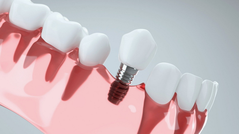 Do You Have To Have Anesia for Dental Implant Surgery?