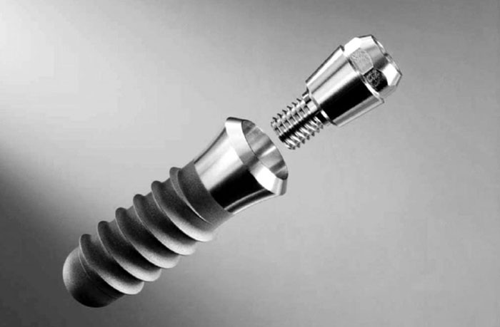 Do You Hav To B Asleep for Dental Implant?