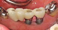//iirorwxhloqjli5p.ldycdn.com/cloud/lrBpkKloljSRilprknnljq/dr-golpa-implant-abutment-screw-size.jpg
