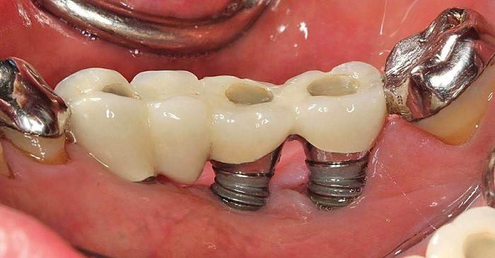 Why Is Abutment Screw Size Important in Dr. Golpa's Implant Procedure?