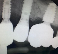 //iirorwxhloqjli5p.ldycdn.com/cloud/lrBpkKloljSRilrkrnlkjo/straumann-abutment-screw-removal-kit.jpg