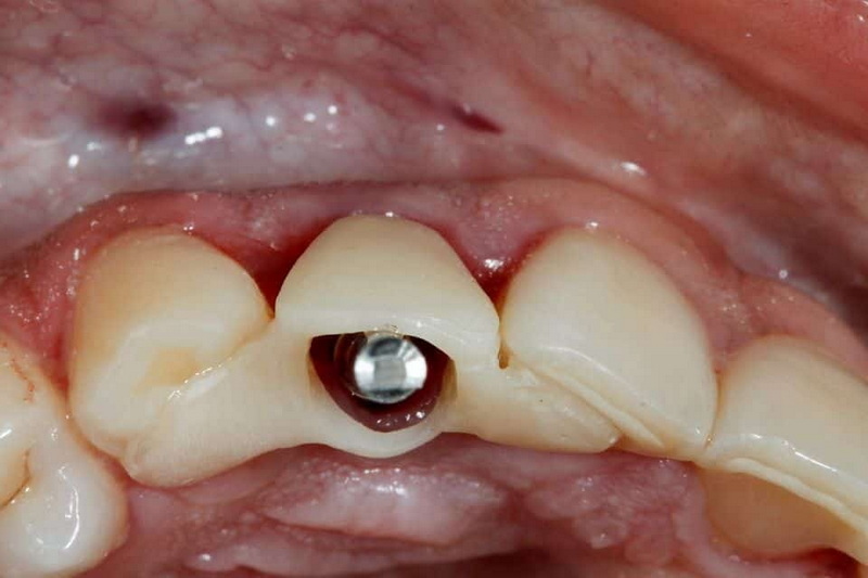 straumann implant healing abutment