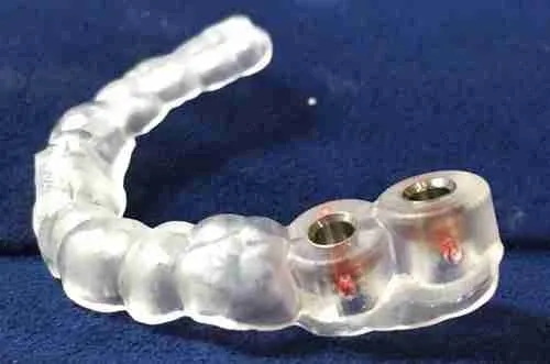how much do dental implant dentures cost_22