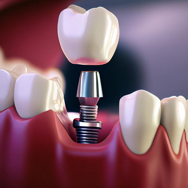How Long Does A Dental Implant Surgery Take?