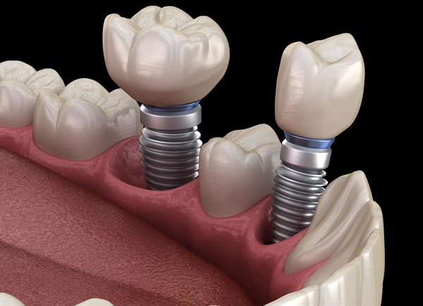 How Long for Dental Implant To Integrate?
