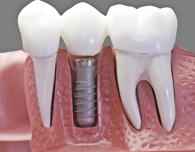 how to find the best dental implant dentist