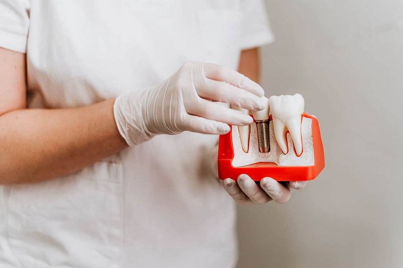 how long after dental implant surgery can i exercise_14