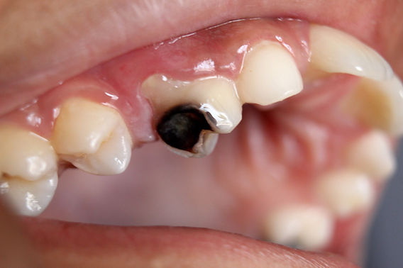 Why No Alcohol After Dental Implant?
