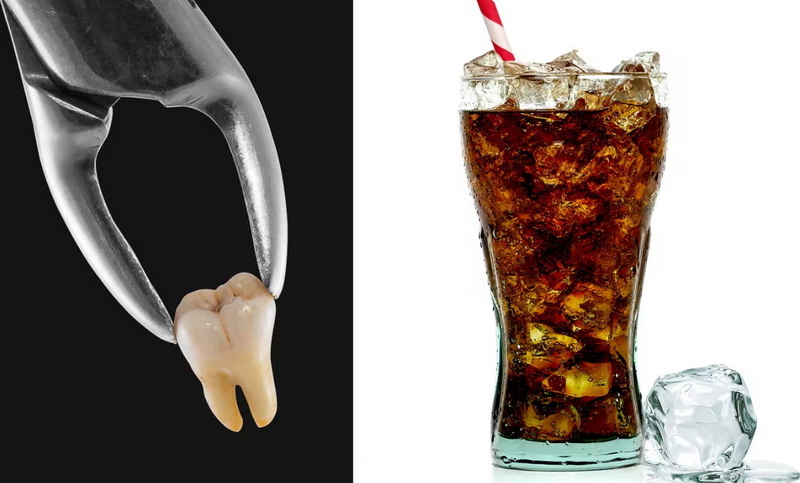 can drink carbonated drinks after dental implant surgery_3