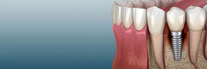 Can You Kiss After Dental Implant Surgery?