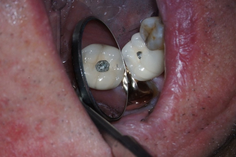 Can A Loose Dental Implant Be Repaired?