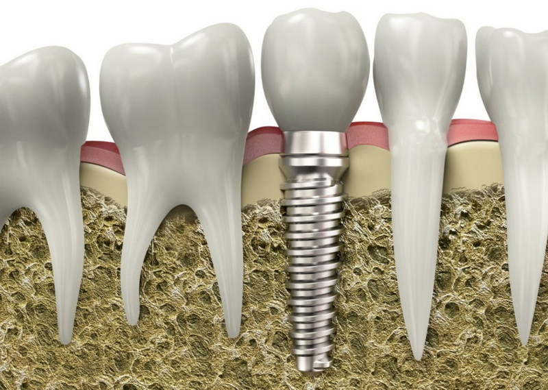 dental implant