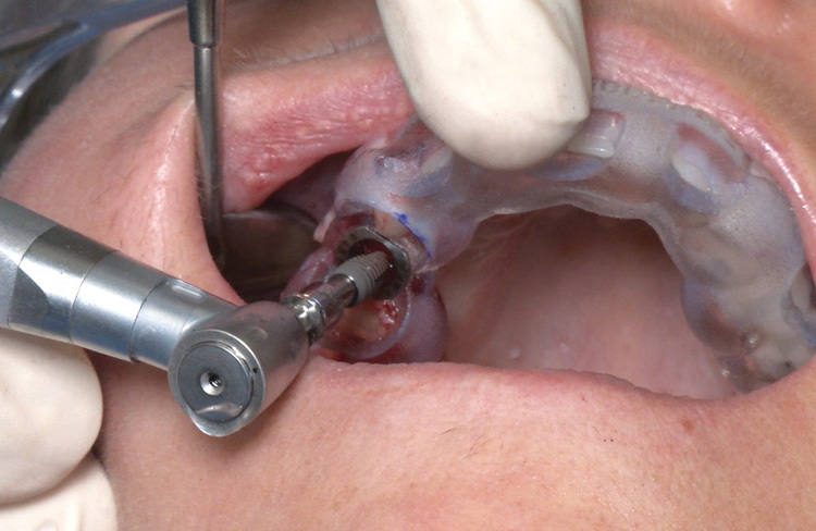how to tell if a dental implant is failing_4