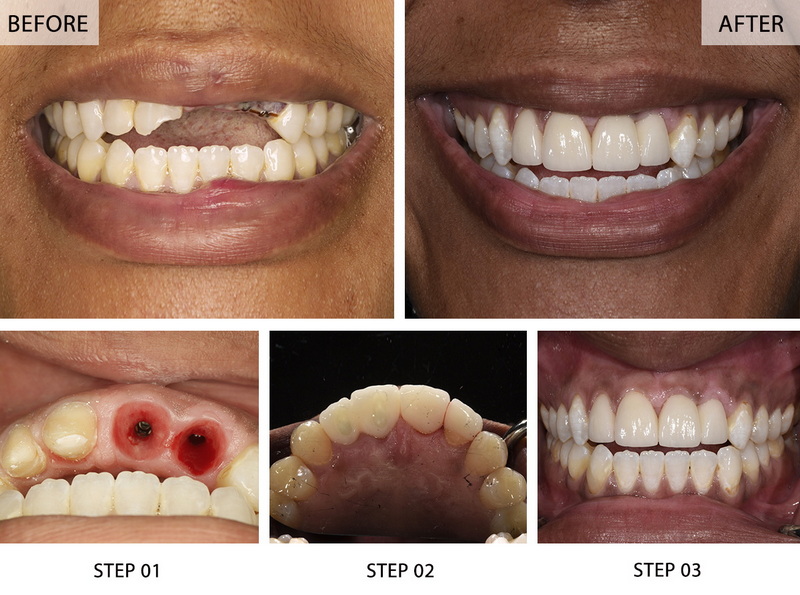 What To Do before Dental Implant Surgery?