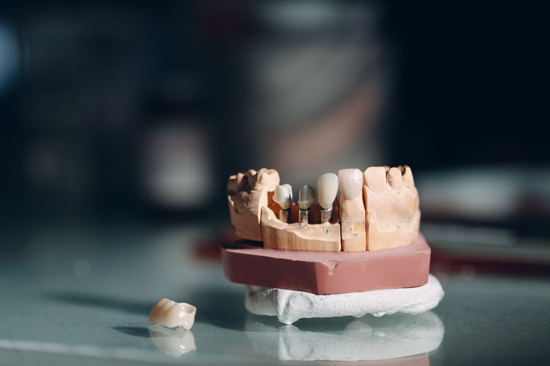 what happens when dental implant is loose_1