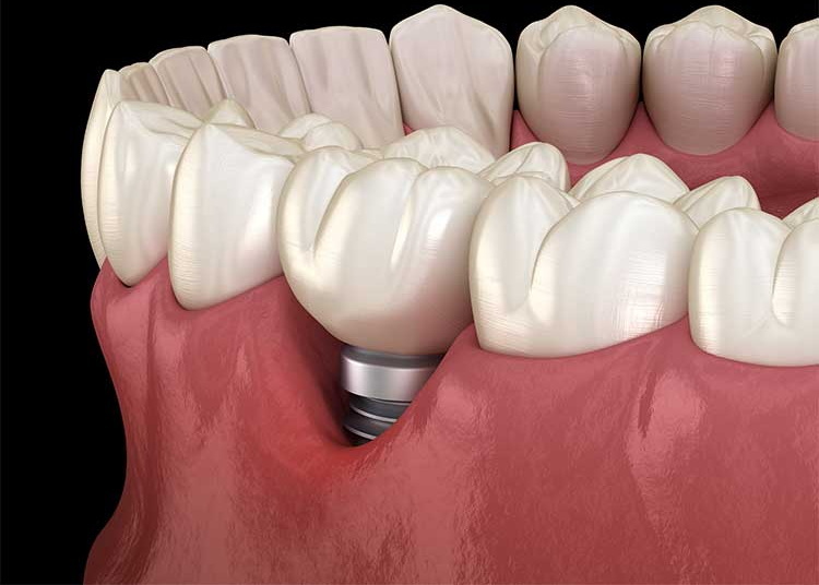 what to do if dental implant is infected_3