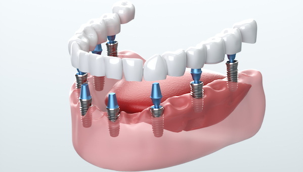 the average cost of a full dental implant_3