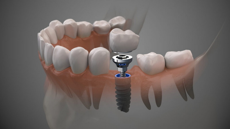 What Happens If A Dental Implant Gets Infected?