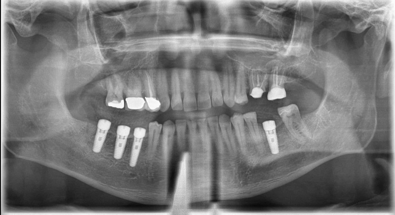What Happens If Dental Implant Moves?